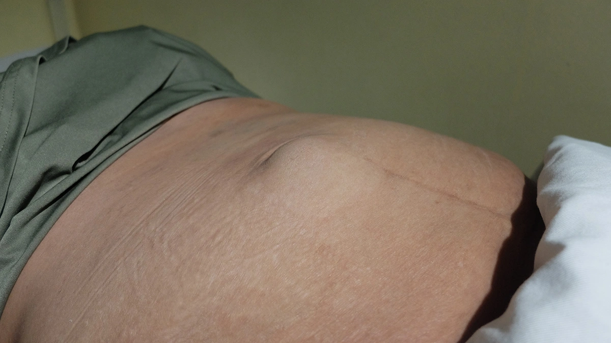 Close-up of the presence of a hernia in a patient